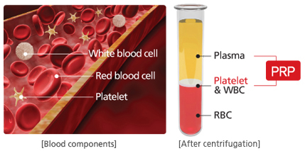prp plasma platelet rich blood cell centrifuge centrifugation whole red stem after therapy application clinical obtaining